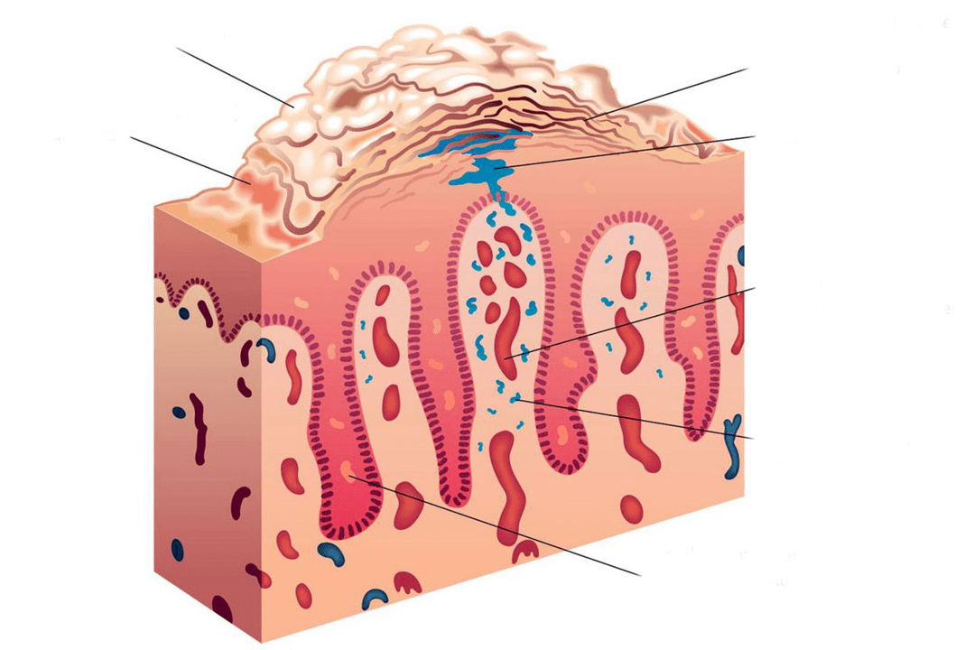 mặt cắt của da trong bệnh vẩy nến
