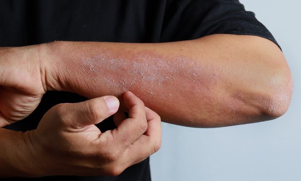 các triệu chứng bệnh vẩy nến trên cánh tay