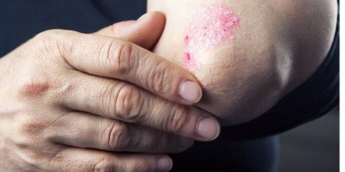 các triệu chứng của bệnh vẩy nến trên khuỷu tay