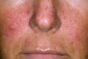 triệu chứng của vẩy trên mặt