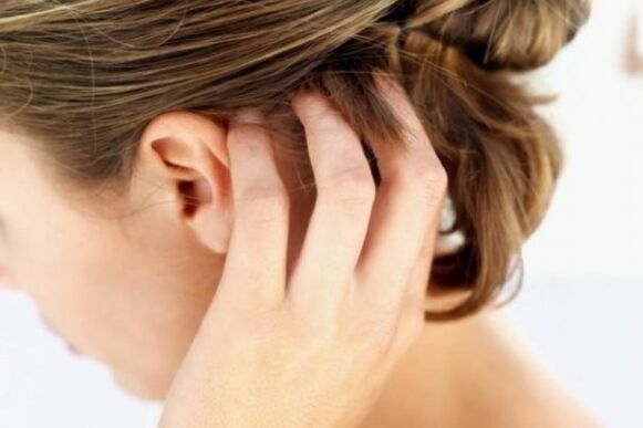 Da đầu ngứa ngáy khó chịu là dấu hiệu bệnh vẩy nến ở giai đoạn cấp tính