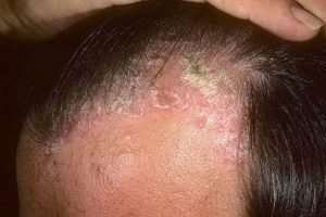 Nhiễm trùng dương trên da đầu