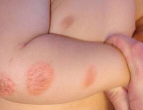 các triệu chứng của bệnh vẩy nến ở trẻ em